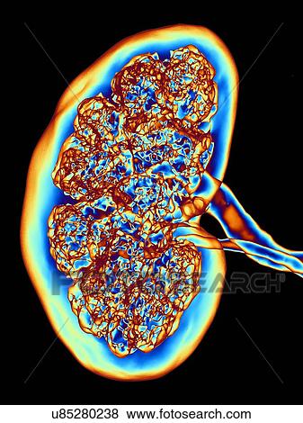 Stock Photo - Kidney, CT scan. False colour 3-D computed tomography (CT) scan of a kidney in frontal view.. Fotosearch