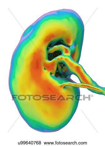Stock Photo - Kidney, CT scan. False colour 3-D computed tomography (CT) scan of a kidney in frontal view.. Fotosearch