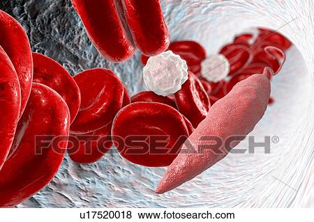 Stock Photo - Leishmania sp. protozoa in blood, computer illustration. This parasite causes the tropical disease leishmaniasis. This can take several forms, causing open sores on the skin or potentially fatal liver damage. It is transmitted by the bites of infected.... Fotosearch