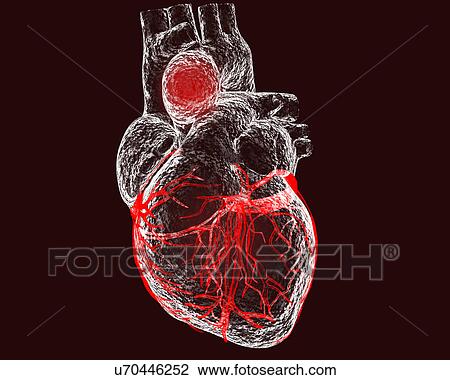 Stock Image - Aortic aneurysm, illustration. Fotosearch