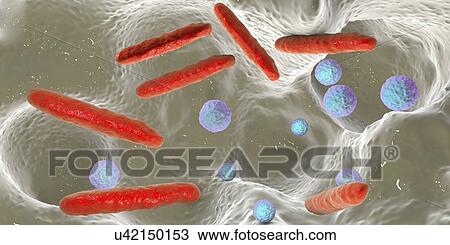 Stock Image - Bacteria inside dental cavity, illustration. Fotosearch