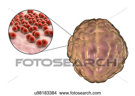 Picture - Bacterial meningitis, illustration. Fotosearch
