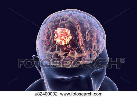 Stock Image - Brain cancer, artwork. Fotosearch