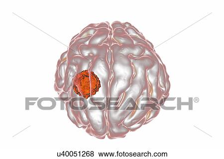 Brain cancer, artwork View Large Photo Image Stock Photo - Brain cancer, artwork. Fotosearch