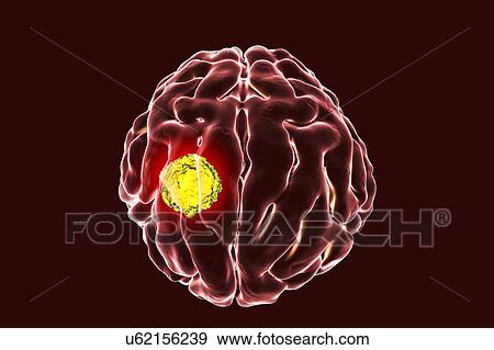 Stock Photo - Brain cancer, artwork. Fotosearch