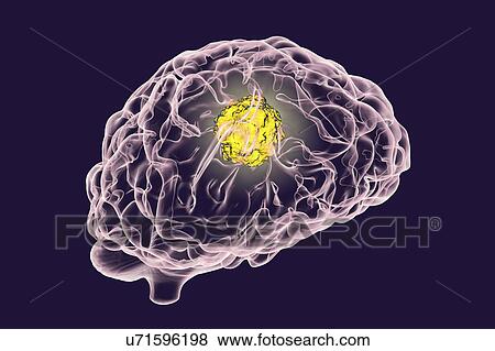 Stock Photo - Brain cancer, artwork. Fotosearch
