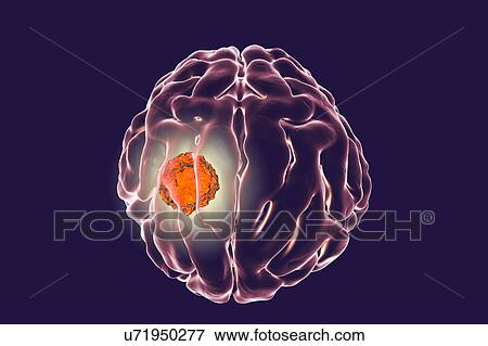 Stock Photo - Brain cancer, artwork. Fotosearch