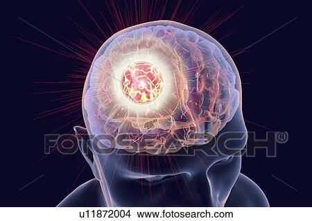 Picture - Brain cancer treatment, illustration. Fotosearch
