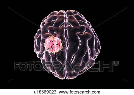 Stock Image - Brain cancer treatment, illustration. Fotosearch