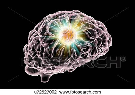 Stock Image - Brain cancer treatment, illustration. Fotosearch