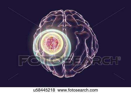 Brain cancer treatment, illustration View Large Photo Image Stock Photo - Brain cancer treatment, illustration. Fotosearch