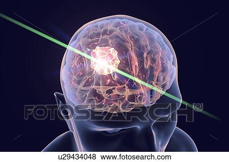 Brain cancer treatment with laser, illustration View Large Photo Image Stock Photo - Brain cancer treatment with laser, illustration. Fotosearch