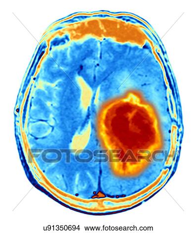 Picture - Brain tumour. Fotosearch