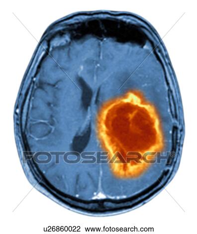 Stock Image - Brain tumour. Fotosearch