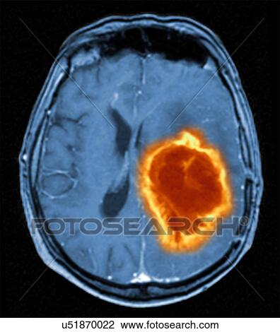 Brain tumour View Large Photo Image Stock Image - Brain tumour. Fotosearch