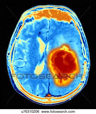 Brain tumour View Large Photo Image Stock Photograph - Brain tumour. Fotosearch