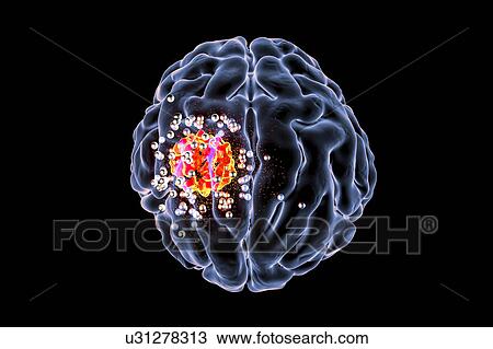 Cancer treatment with nanotechnology, illustration View Large Photo Image Stock Image - Cancer treatment with nanotechnology, illustration. Fotosearch