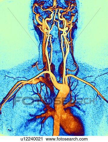 Chest, neck and head arteries, MRA scan View Large Photo Image Stock Image - Chest, neck and head arteries, MRA scan. Fotosearch