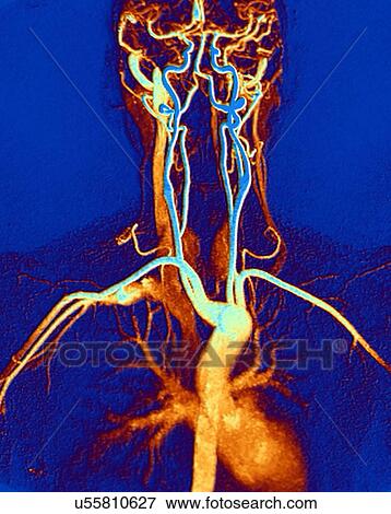Chest, neck and head arteries, MRA scan View Large Photo Image Stock Photo - Chest, neck and head arteries, MRA scan. Fotosearch