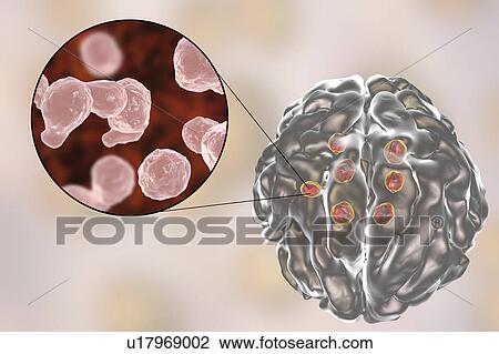 Stock Image - Cryptococcal brain lesions, illustration. Fotosearch