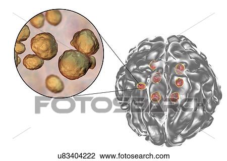 Stock Image - Cryptococcal brain lesions, illustration. Fotosearch