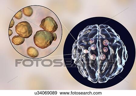 Cryptococcal brain lesions, illustration View Large Photo Image Stock Photo - Cryptococcal brain lesions, illustration. Fotosearch