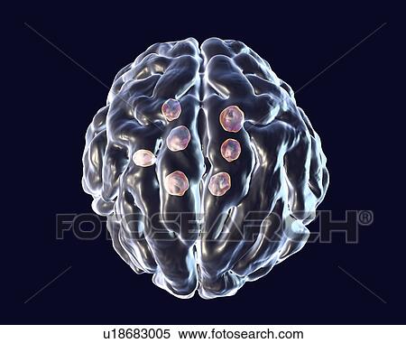 Cryptococcal brain lesions, illustration View Large Photo Image Stock Photography - Cryptococcal brain lesions, illustration. Fotosearch