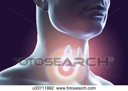 Stock Image - Destruction of thyroid tumour, illustration. Fotosearch