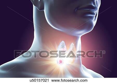 Stock Image - Destruction of thyroid tumour, illustration. Fotosearch