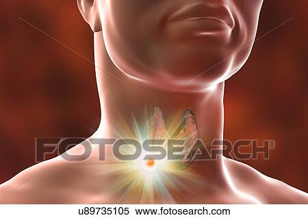Stock Photography - Destruction of thyroid tumour, illustration. Fotosearch