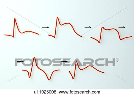 Stock Photo - ECG in myocardial infarction, illustration. Fotosearch