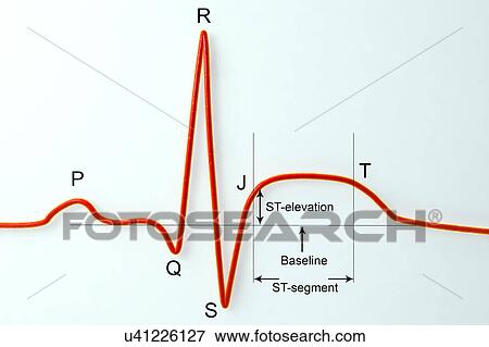 ECG in myocardial infarction, illustration View Large Photo Image Stock Photo - ECG in myocardial infarction, illustration. Fotosearch