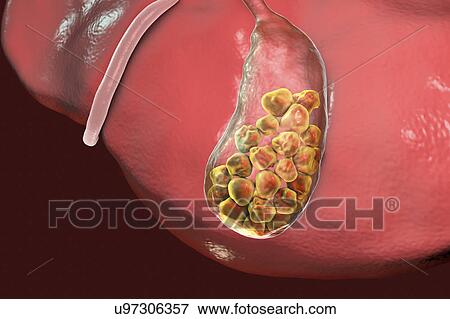 Stock Photo - Gallstones, illustration. Fotosearch