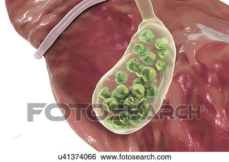 Gallstones, illustration View Large Photo Image Stock Photograph - Gallstones, illustration. Fotosearch