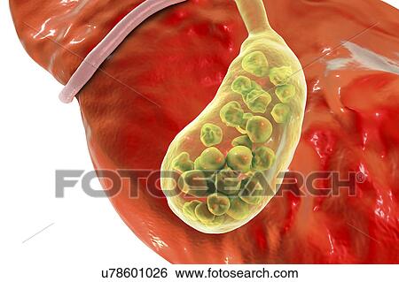 Stock Photograph - Gallstones, illustration. Fotosearch