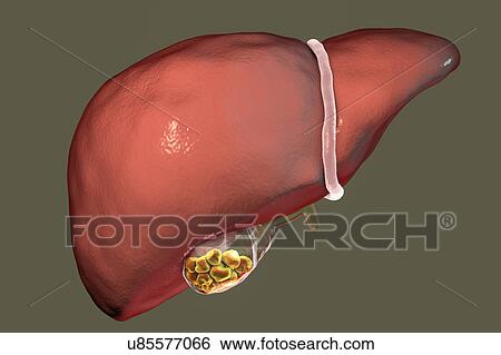 Stock Photograph - Gallstones, illustration. Fotosearch