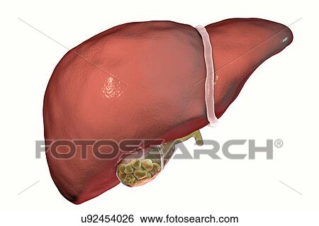 Stock Photograph - Gallstones, illustration. Fotosearch