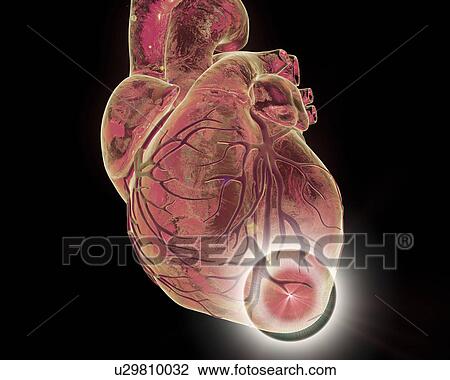 Stock Image - Heart attack, conceptual illustration. Fotosearch