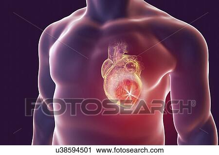 Stock Image - Heart attack, conceptual illustration. Fotosearch