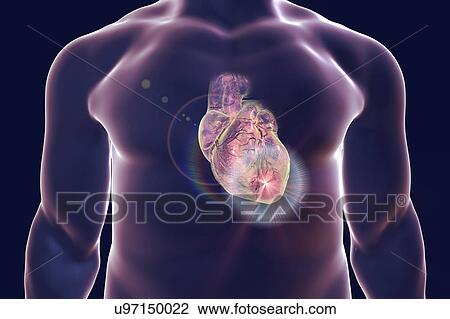 Heart attack, conceptual illustration View Large Photo Image Stock Image - Heart attack, conceptual illustration. Fotosearch