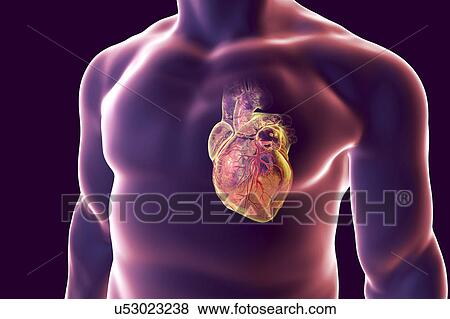Stock Photo - Heart attack, conceptual illustration. Fotosearch