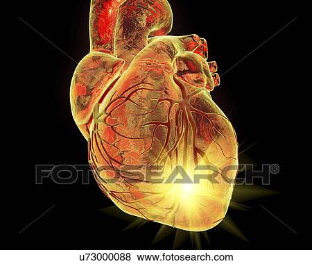 Heart attack, conceptual illustration View Large Photo Image Stock Photo - Heart attack, conceptual illustration. Fotosearch