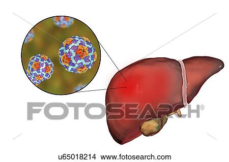 Picture - Hepatitis A, illustration. Fotosearch