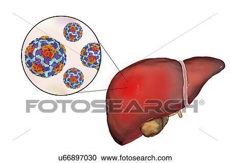 Stock Image - Hepatitis A, illustration. Fotosearch