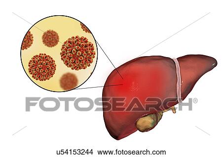 Picture - Hepatitis B, illustration. Fotosearch