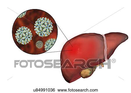 Hepatitis B, illustration View Large Photo Image Stock Photograph - Hepatitis B, illustration. Fotosearch