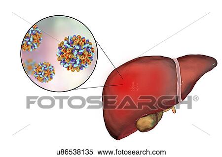 Stock Photography - Hepatitis B, illustration. Fotosearch