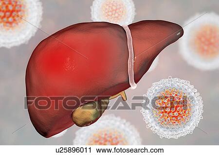 Stock Image - Hepatitis C, illustration. Fotosearch