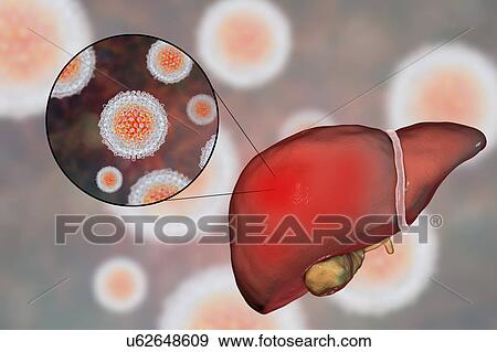 Hepatitis C, illustration View Large Photo Image Stock Photo - Hepatitis C, illustration. Fotosearch