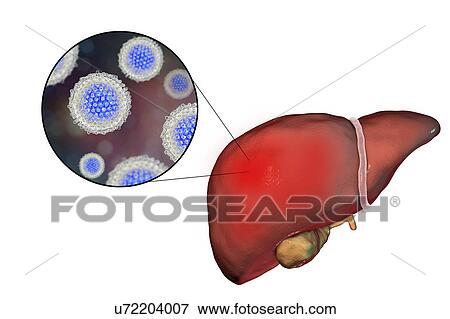 Hepatitis C, illustration View Large Photo Image Stock Photo - Hepatitis C, illustration. Fotosearch